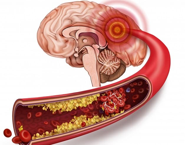 Biến chứng của rối loạn nhịp tim