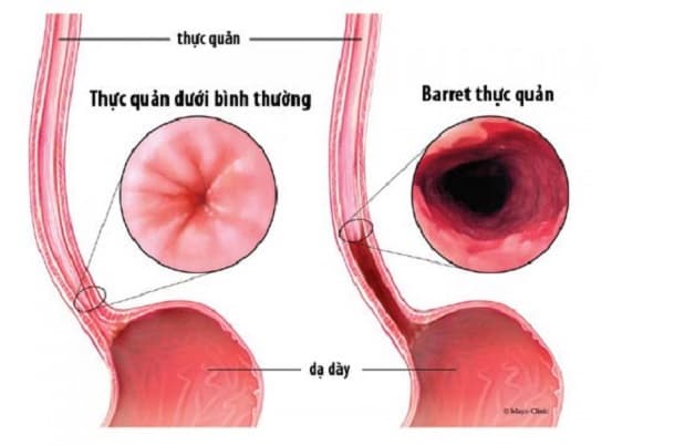 barret thực quản biến chứng của trào ngược dạ dày