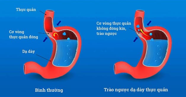 biến chứng của trào ngược dạ dày viêm loét thực quản