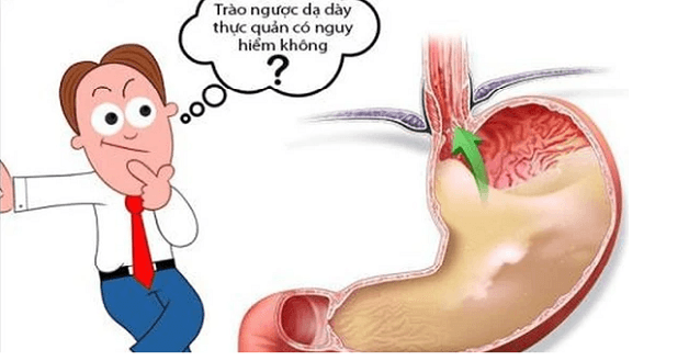 cấp độ biến chứng của trào ngược dạ dày