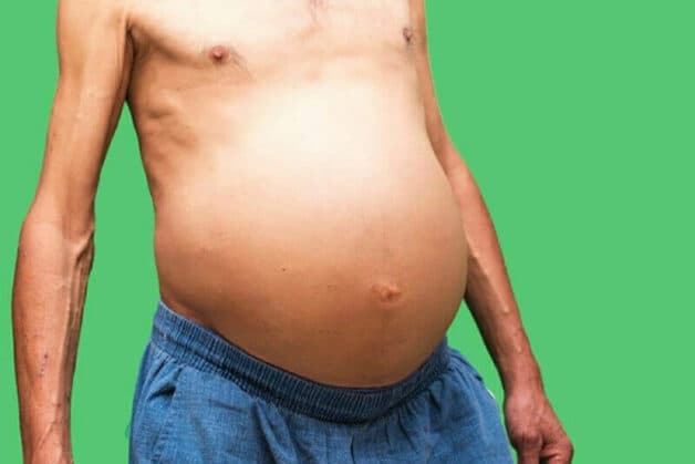 Những người bị chai gan có thể bị tích tụ chất lỏng trong ổ bụng gây tình trạng chướng bụng