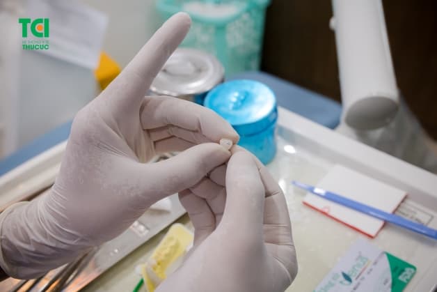 Bọc răng sứ bị hở