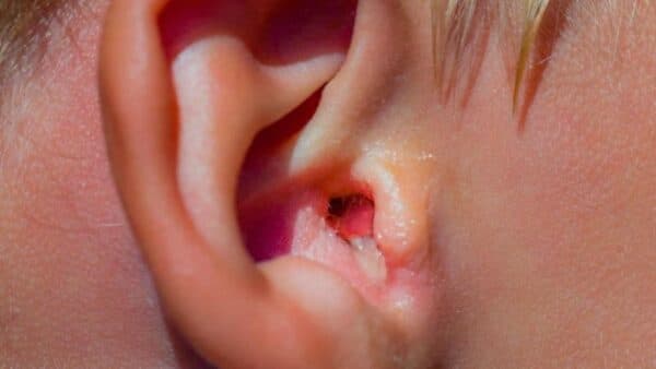 cách chữa viêm tai