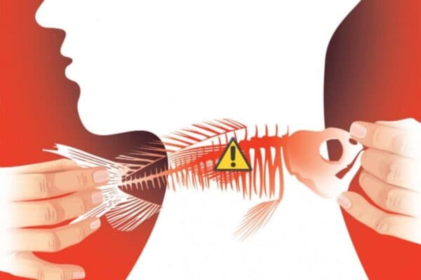 Hóc xương cá là cấp cứu thường gặp do mọi người bất cẩn khi ăn uống