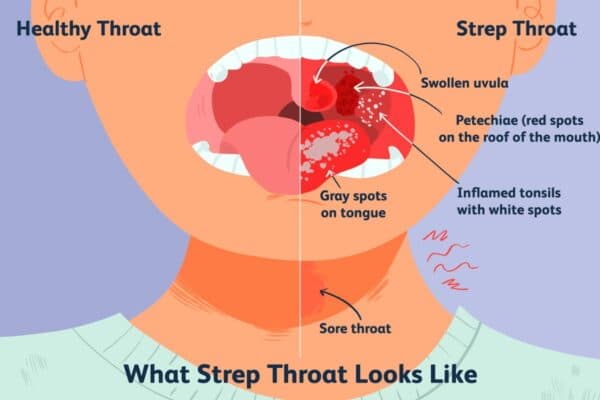 Viêm họng là tình trạng niêm mạc họng bị nhiễm trùng