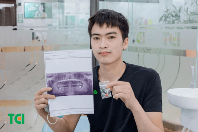 Cơn đau ám ảnh khi nhổ răng khôn bị sót chân răng - 1