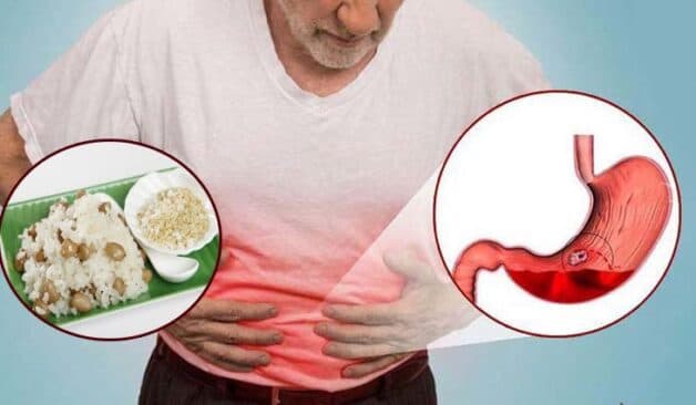 Viêm loét dạ dày ăn xôi được không là câu hỏi nhiều người thắc mắc