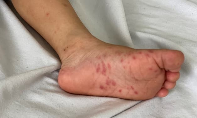 dấu hiệu trẻ bị tay chân miệng