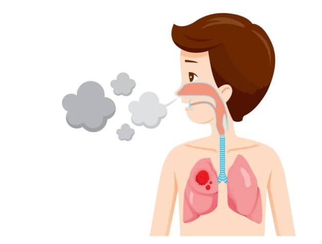 Tìm hiểu những dấu hiệu ung thư phổi ở giai đoạn đầu