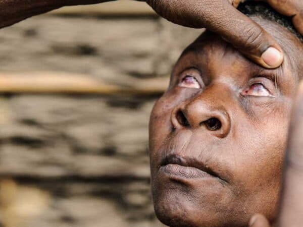 Đau mắt hột gây biến chứng nguy hiểm như mù lòa