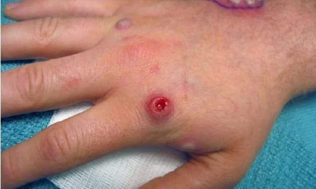 đậu mùa là bệnh gì