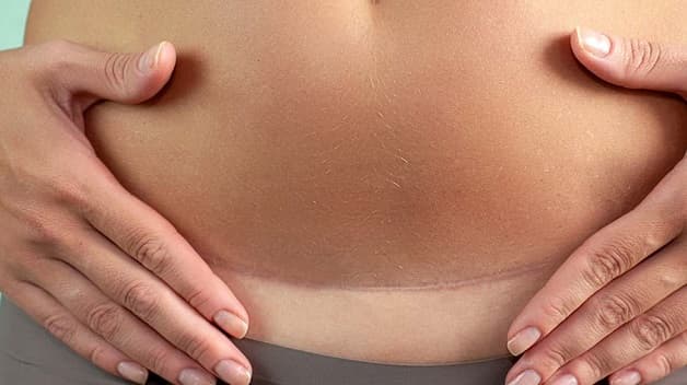 Đẻ mổ là một thủ thuật phẫu thuật lấy thai nhi thông qua vết rạch ở bụng