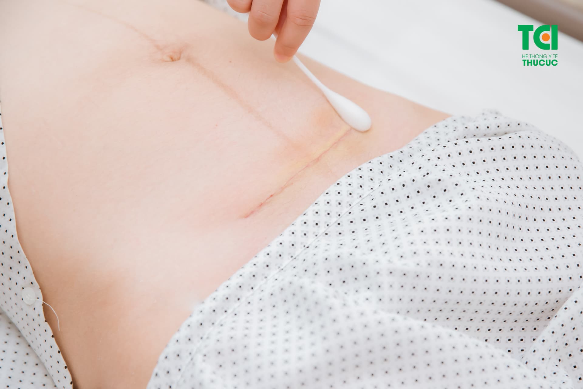 Đẻ mổ sau bao lâu thì tập thể dục được là thắc mắc chung của nhiều mẹ bỉm sữa