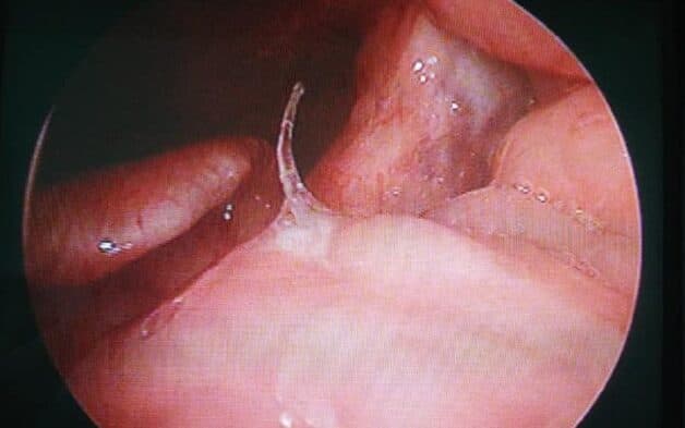 Dị vật khu vực họng