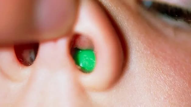 Dị vật mũi bỏ quên ở trẻ