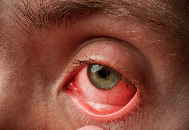 Nguyên nhân viêm kết mạc có thể do vi khuẩn, virus hoặc dị ứng gây ra