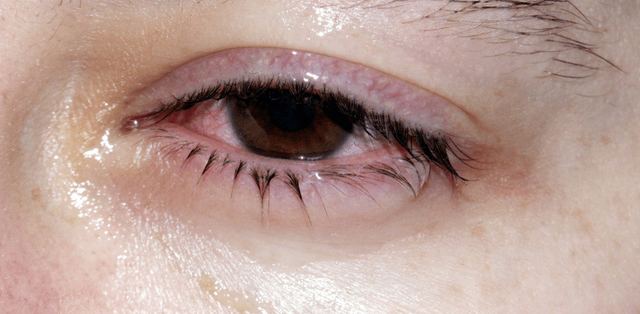 Điều trị viêm kết mạc cấp có khó không?