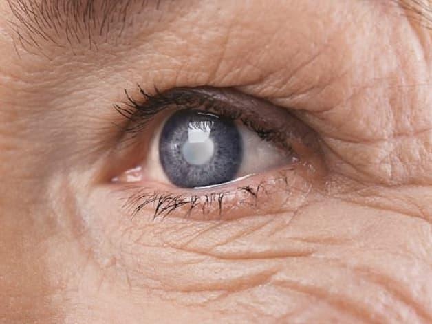 đục thủy tinh thể là gì