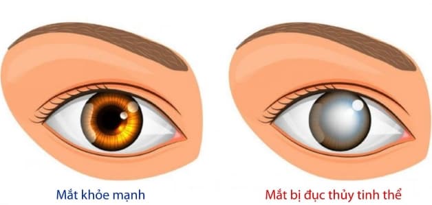 đục thủy tinh thể ở người tiểu đường là gì