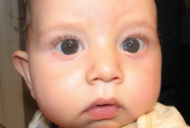 đục thủy tinh thể ở trẻ sơ sinh nguy hiểm