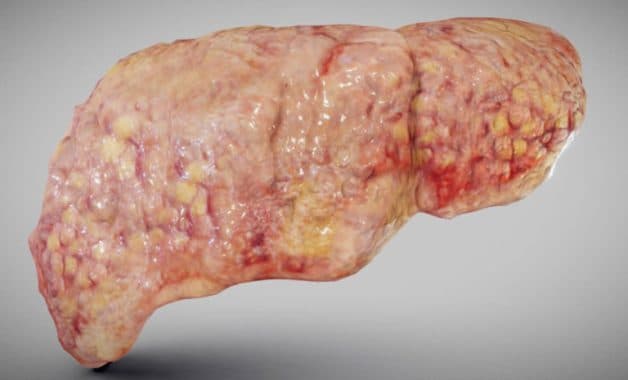 ung thư gan ác tính từ gan nhiễm mỡ