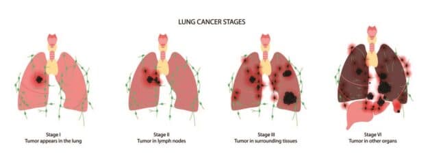 Điểm danh những triệu chứng ung thư phổi