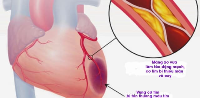 Nhồi máu cơ tim điều trị ra sao và những lưu ý sau đó
