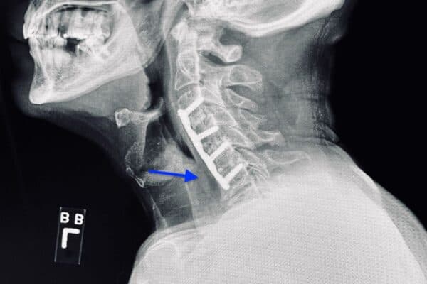 Mắc dị vật họng và tình trạng thường gặp ở không ít người