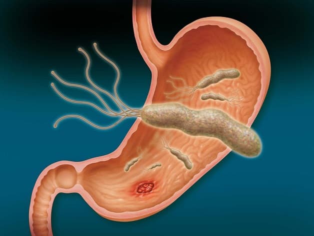 Vi rút hp gây viêm loét dạ dày là bệnh lý khá phổ biến
