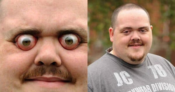 Mắt bị lồi là gì?