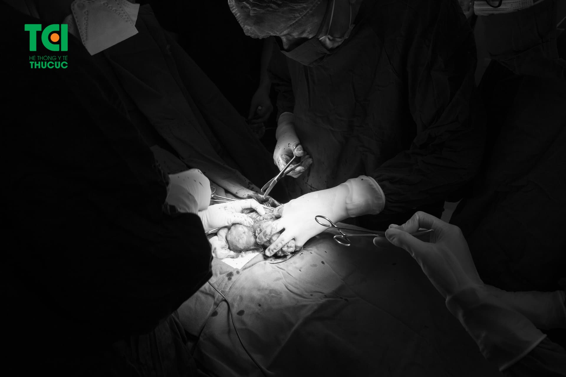 Phẫu thuật bóc tác u xơ tử cung khủng tại Bệnh viện ĐKQT Thu Cúc TCI