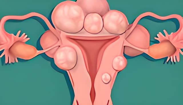 Nguyên nhân của u xơ tử cung, triệu chứng hay gặp &amp; cách điều trị