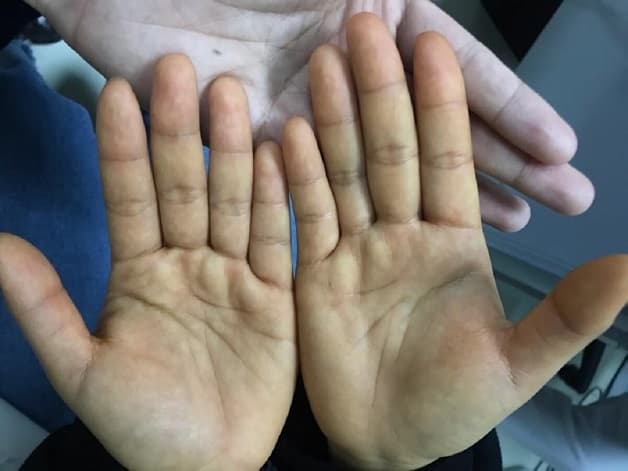 Nguyên nhân gây ung thư gan vàng da