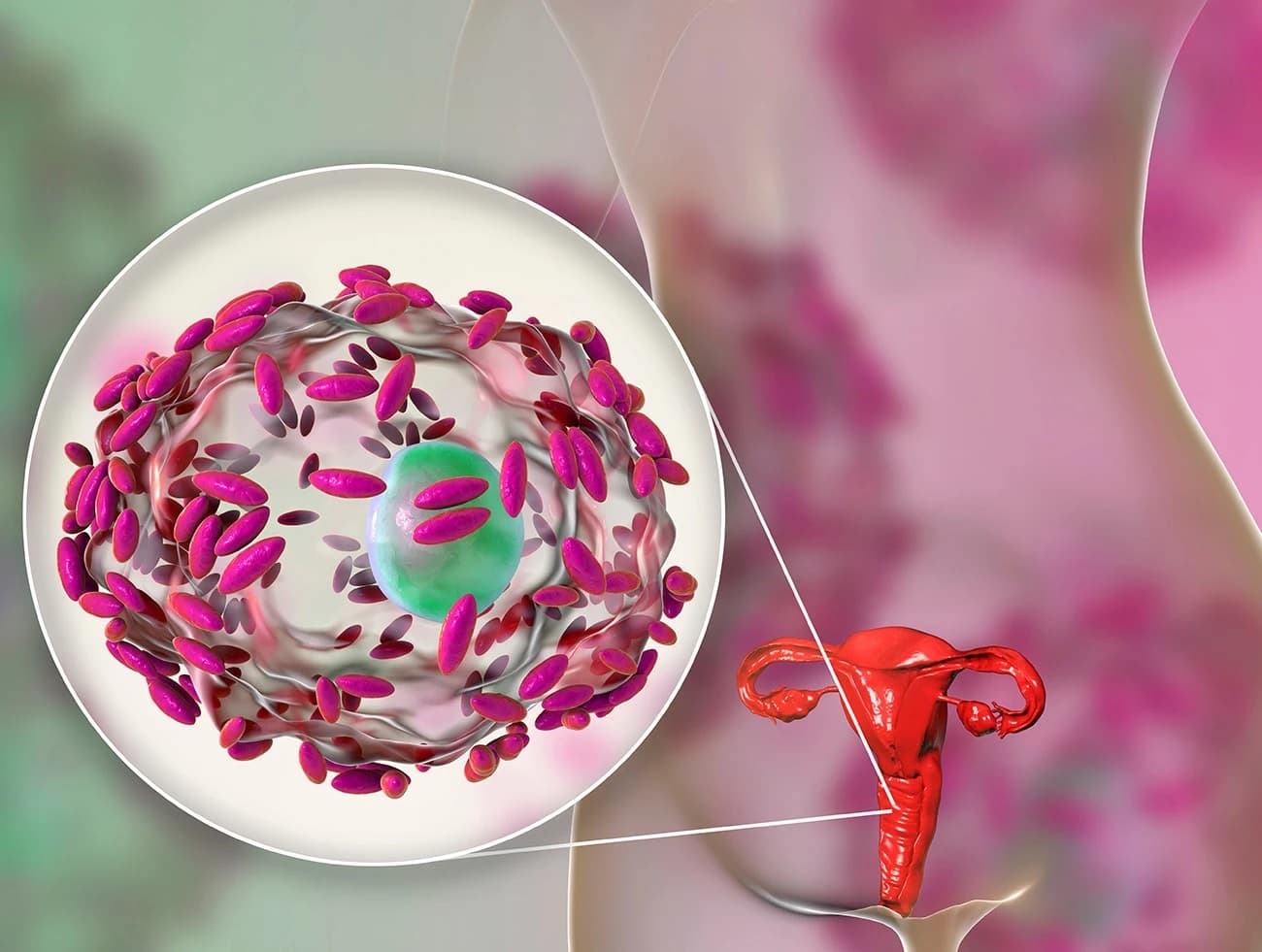 Viêm âm đạo là tình trạng âm đạo bị nhiễm trùng do sự xâm nhập của các tác nhân gây viêm nhiễm như nấm, vi khuẩn, ký sinh trùng,... 