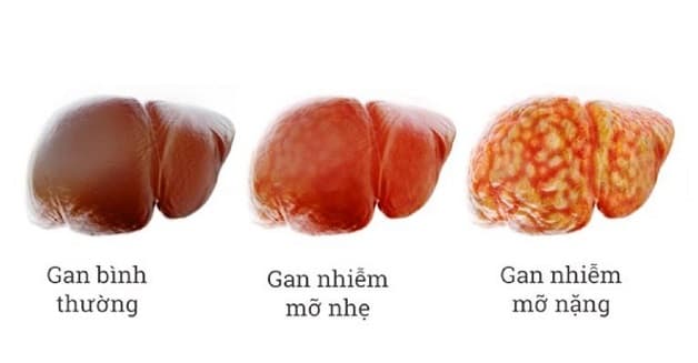 Gan nhiễm mỡ là gì?