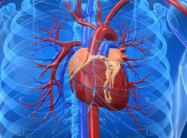 Thiếu máu cục bộ sẽ dẫn đến tình trạng nhồi máu cơ tim