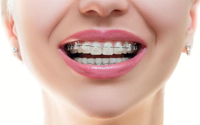Niềng răng mắc cài pha lê có hiệu quả?