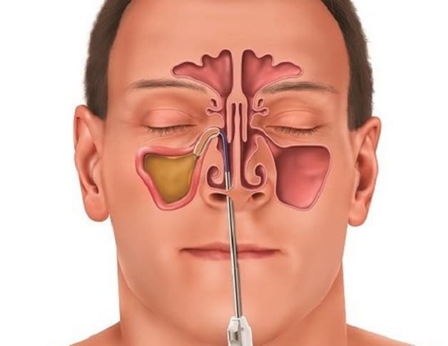 nội soi mũi có đau không