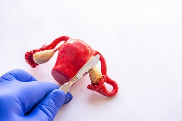 Ung thư buồng trứng diễn biến ở giai đoạn 3 và cách điều trị