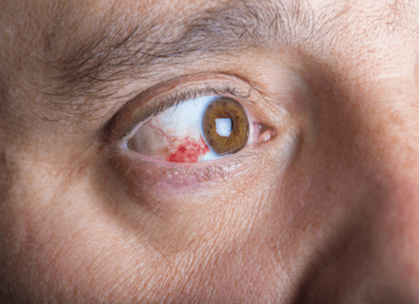 Rách giác mạc là gì?