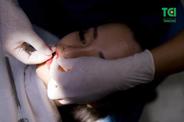 răng cửa mọc lệch