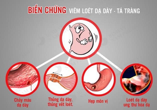 nguyên nhân sinh lý bệnh loét dạ dày tá tràng