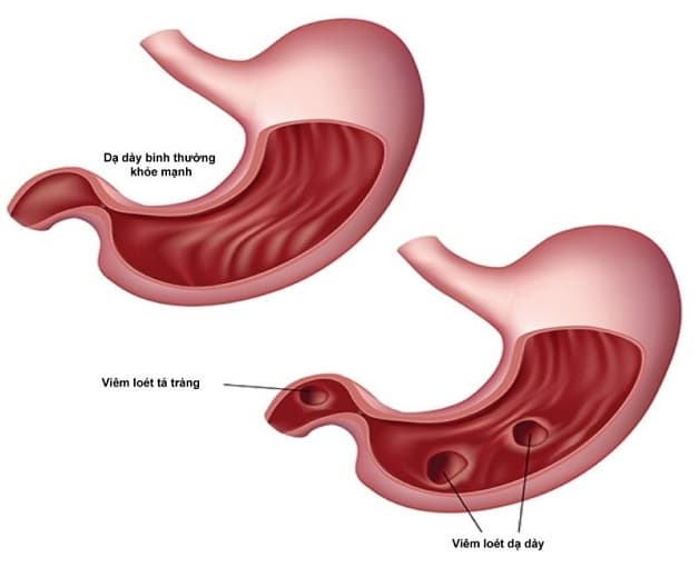 sinh lý bệnh loét dạ dày tá tràng