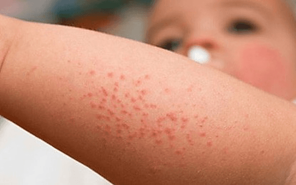 sốt xuất huyết ở trẻ em