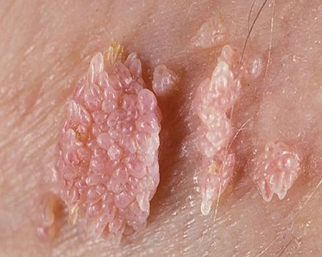 Các nốt sùi mào gà thường rất nhỏ, chúng cũng có thể mọc thành từng cụm và dính với nhau ở âm đạo, dương vật, hậu môn, miệng,..