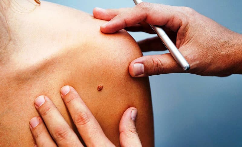 Bệnh sùi mào gà lây qua những con đường nào là câu hỏi của nhiều người