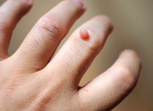 Sùi mào gà lây qua những con đường nào? Cách phòng hiệu quả!