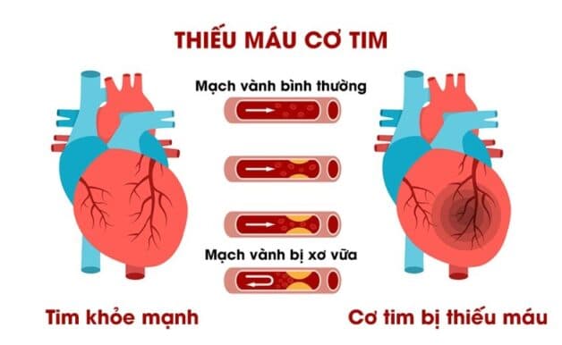 Hình ảnh so sánh tim khỏe mạnh và thiếu máu cơ tim cục bộ