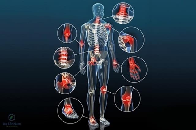 Tìm hiểu về thoái hóa khớp bệnh học