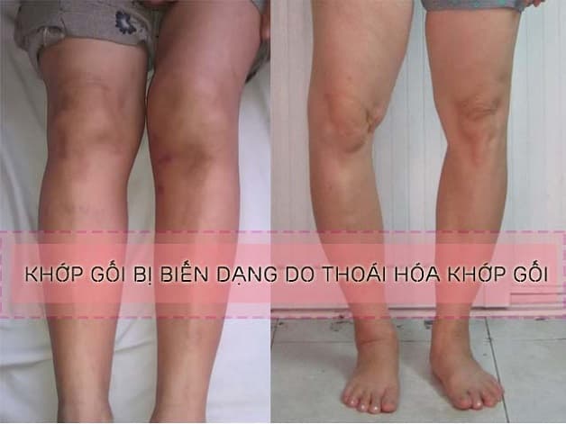 biến dạng khớp gối dao thoái hóa khớp gối